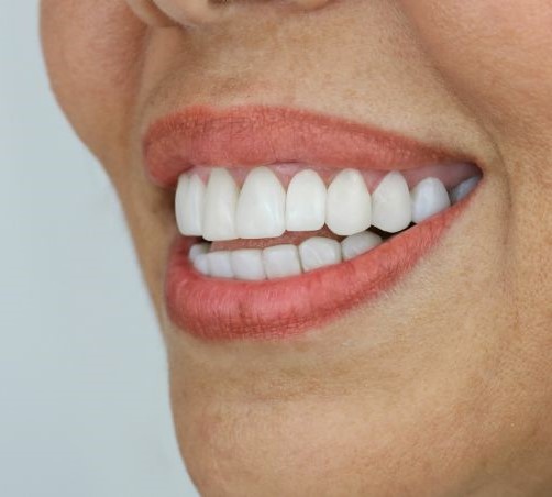 بعد تقويم الأسنان