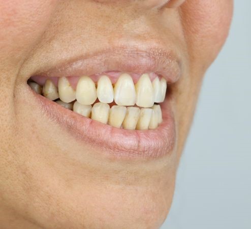 قبل تقويم الأسنان